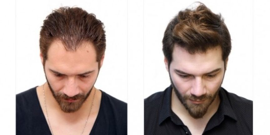 Best Hair Transplant Clinics in Turkey
